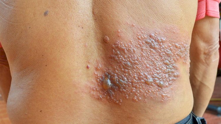 Herpes zóster, causado pelo vírus da catapora, pode ser prevenido com vacinação