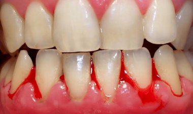 SUA GENGIVA COSTUMA SANGRAR?