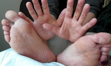 Saiba os sintomas da doença mão-pé-boca, que está causando surto em cidades do Brasil