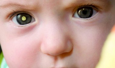 Dia Mundial do Câncer - Retinoblastoma: diagnóstico precoce é a chave para o sucesso do tratamento