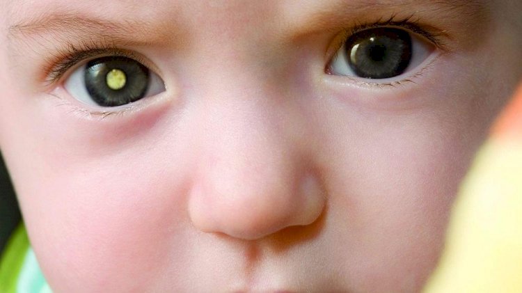 Dia Mundial do Câncer - Retinoblastoma: diagnóstico precoce é a chave para o sucesso do tratamento