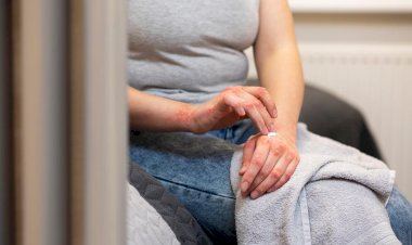 Alvo de preconceito, psoríase atinge cinco milhões de brasileiros