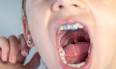 Prevenção e detecção precoce contribuem para reduzir incidência e mortalidade de câncer de boca