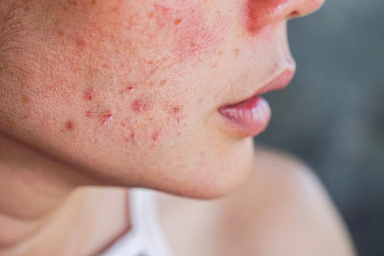 Acne: profissional da Unesc explica causas, efeitos e tratamentos eficazes